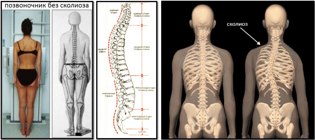 Степени заболевания сколеоза.jpg