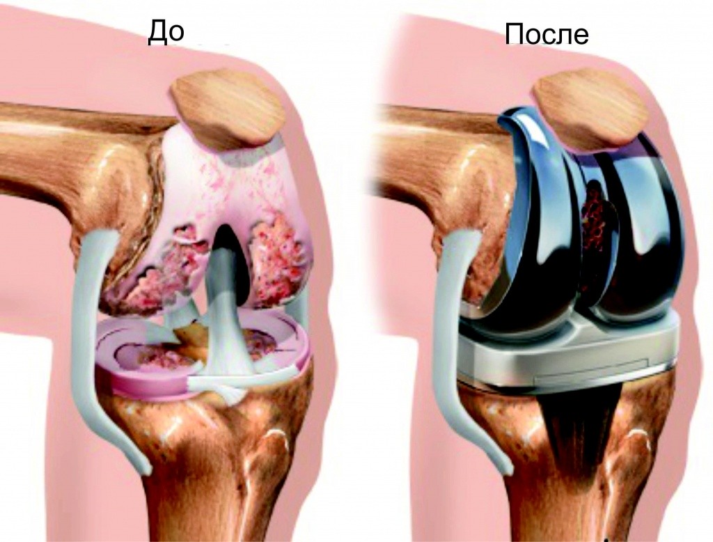 протезированию коленного сустава