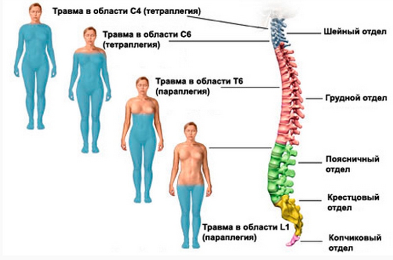 Спинальная травма2.jpg