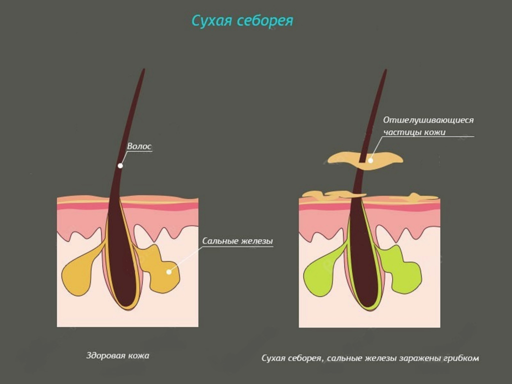 Себорея3.jpg