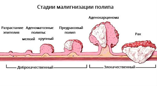 Полипы в желудке2.jpg