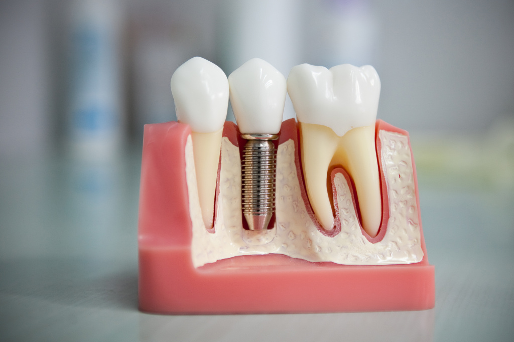  Существует 2 основные группы зубных протезов