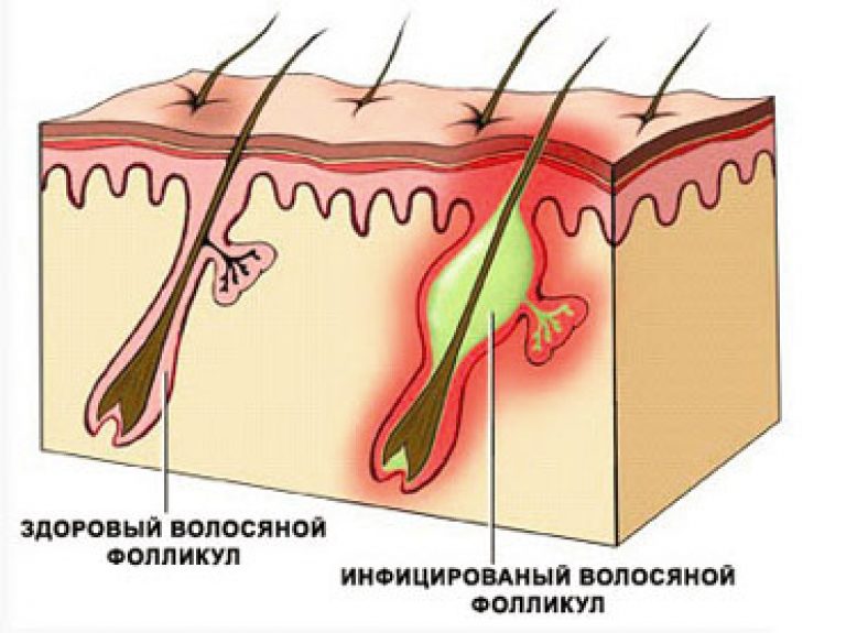 Фолликулит