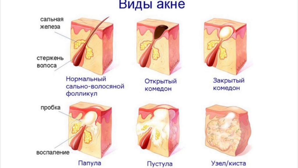 Виды акне.jpg