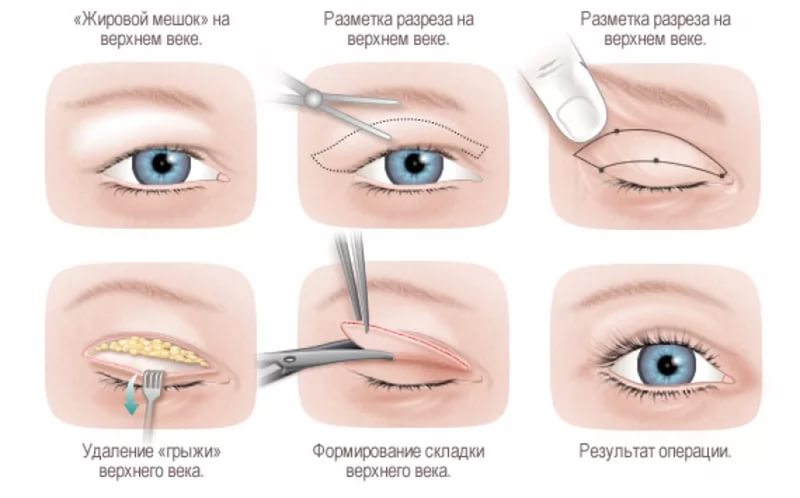 Блефаропластика в Израиле