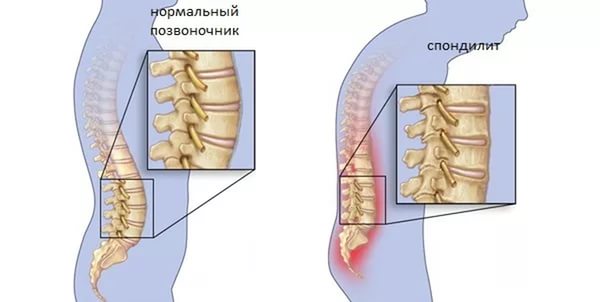 спондилит лечение