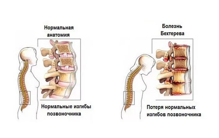 болезнь берхерова лечение