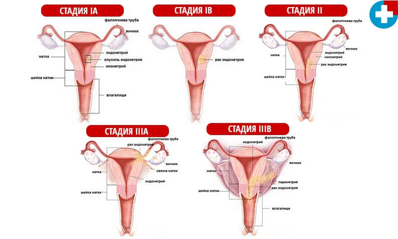 stadii raka endometriya.jpg
