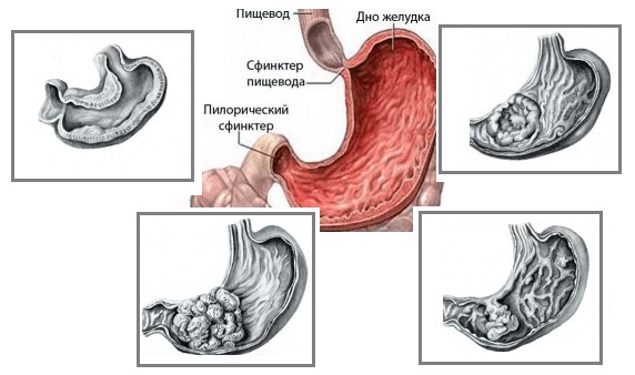 adenokarcinoma zheludka.png