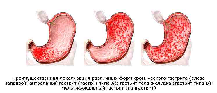 гастрит