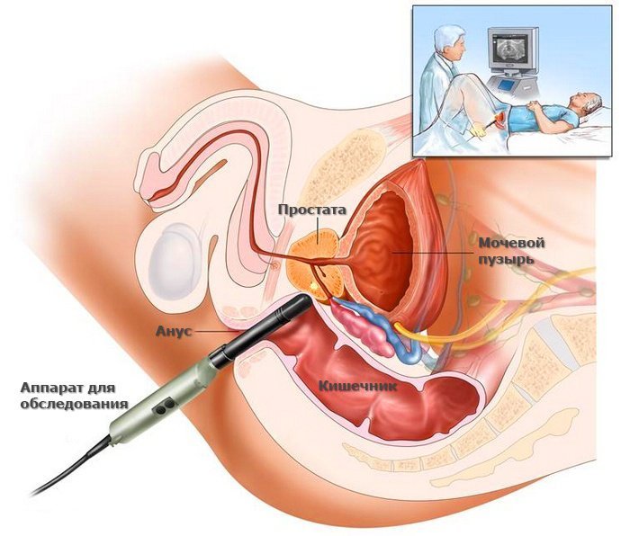 Простатит