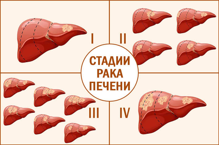 стадии рака.jpg