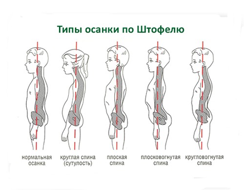 Типы осанки по Штофелю