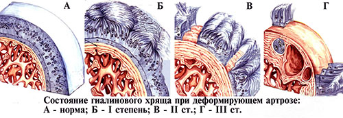 Степени артроза коленного сустава