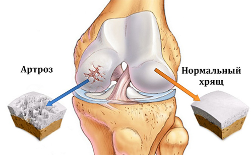Вид поврежденного коленного сустава