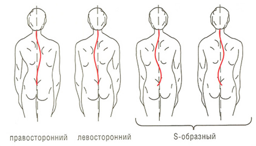 Какие типы искревлений позвоночника бывают при сколиозе