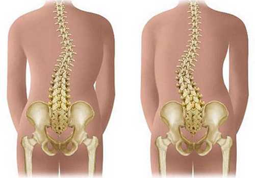Особенности и признаки детского сколиоза