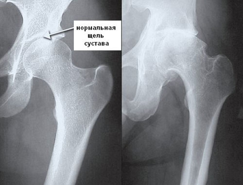 Основные признаки деформирующего коксартроза