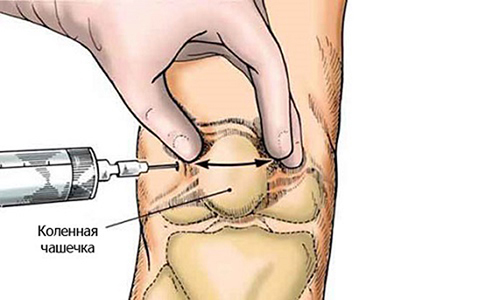 Виды уколов при артрозе коленного сустава