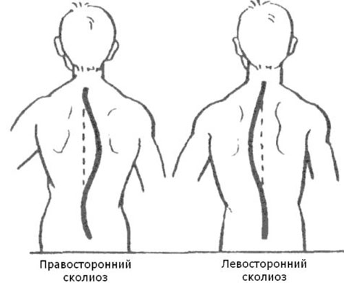 Виды искривления позвоночника