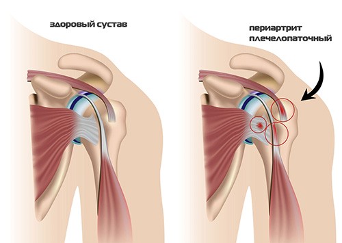 Причины проявления плечелопаточного периартроза