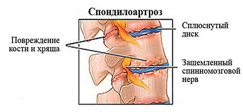 Что такое спондилоартроз? Этапы развития