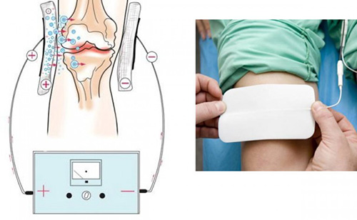 Электрофорез, как один из методов лечения артроза