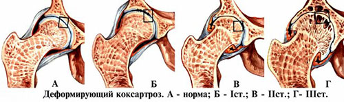 Степени деформирующего артроза