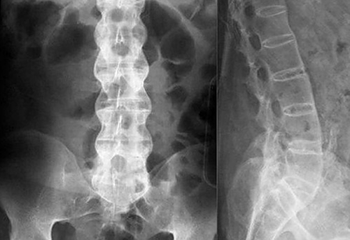 Рентген пояснично-крестцового отдела позвоночника пораженного спондилоартрозом