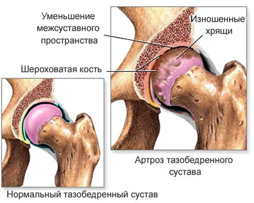 Заболевание коксартроз